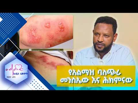 የአልማዝ ባለጭራ መንስኤው እና ሕክምናው /New Life